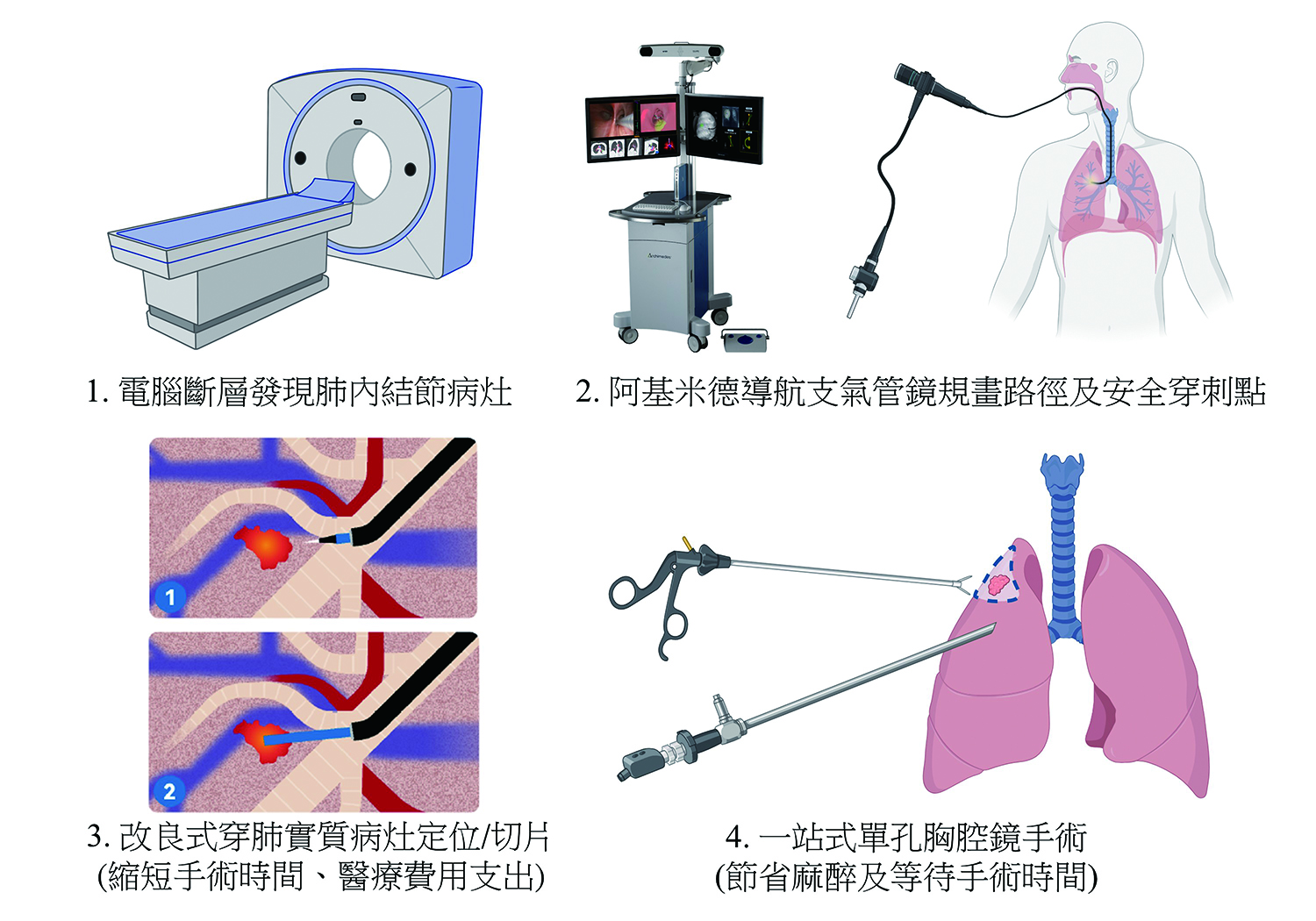 結合改良式導航支氣管鏡與單孔胸腔鏡手術圖說